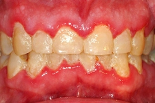 Diş Eti Kızarıklığı Sebepleri ve Sonuçları