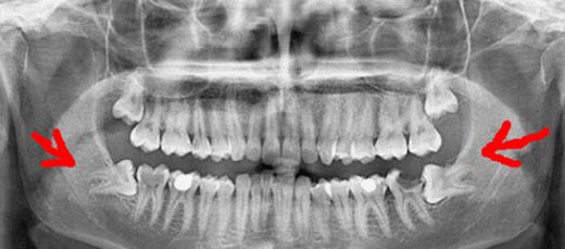 Gömülü Diş Ameliyatı